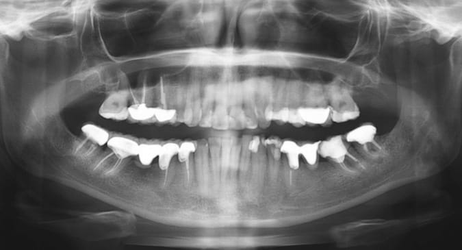 Endodoncia