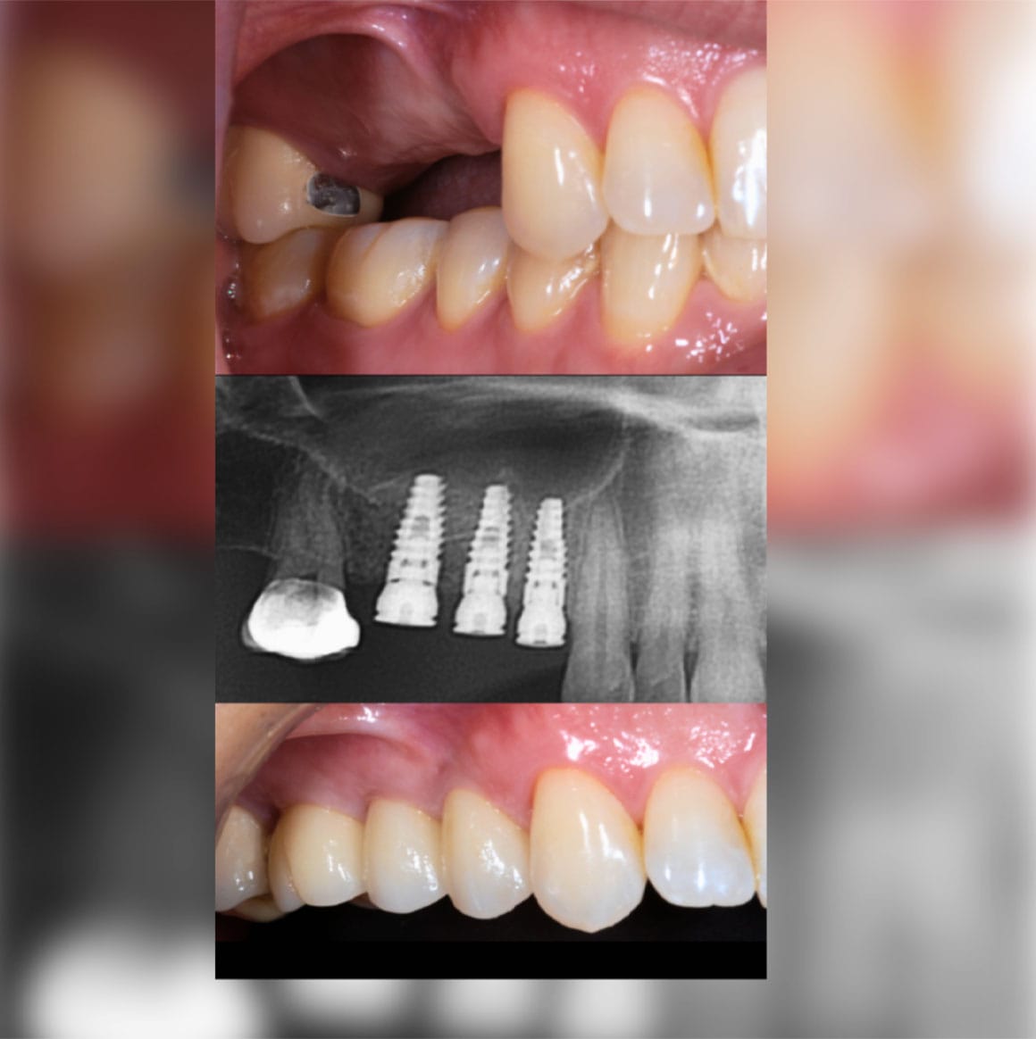 Periodoncia e Implantes